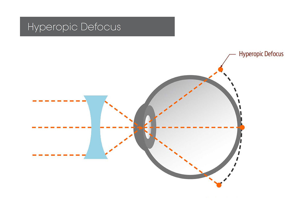 Hyperopic defocus, which occurs with regular glasses and contact lens correction, is linked to increasing myopia progression.