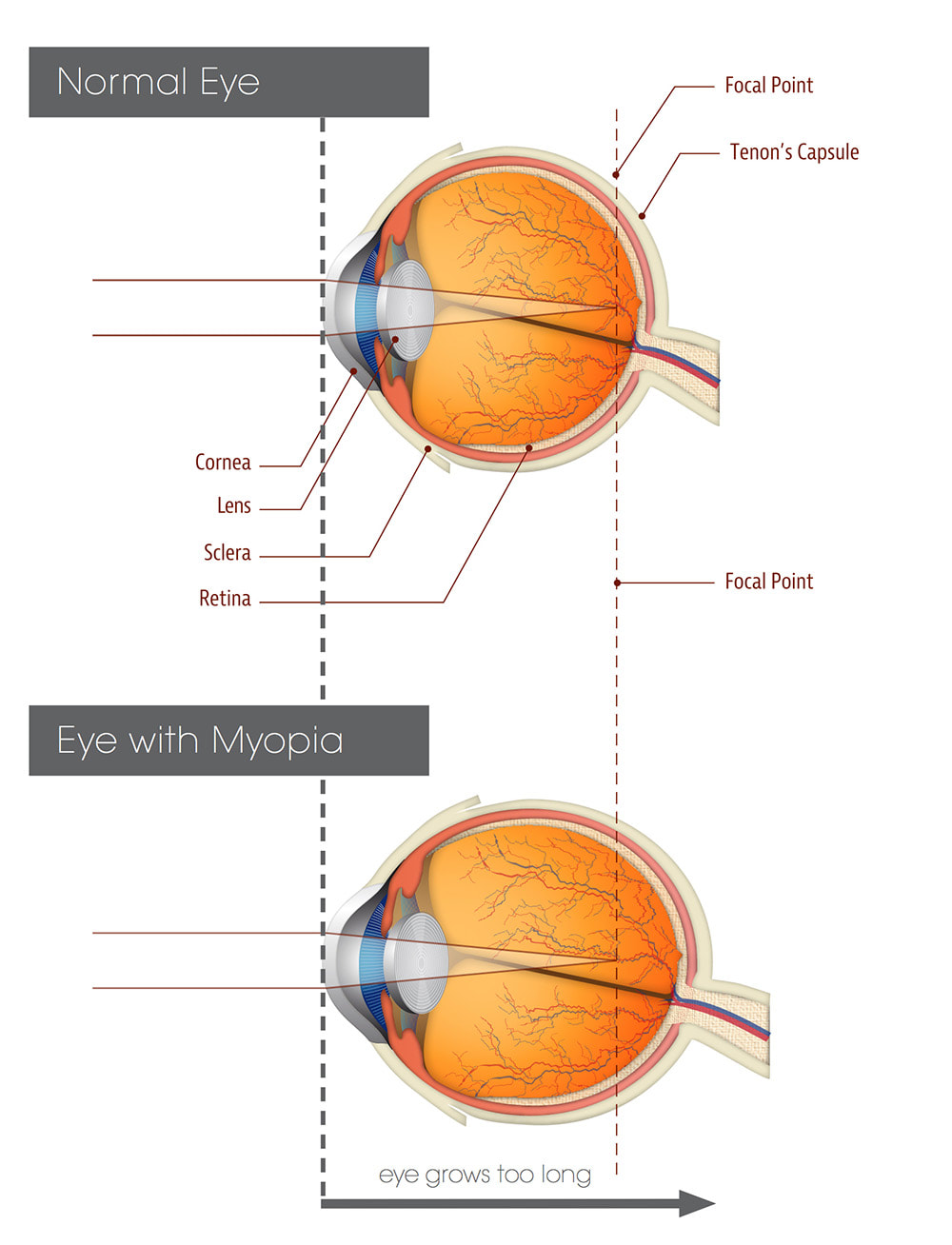 Normal eye compared to an elongated myopic eye that is at higher risk of developing disease.
