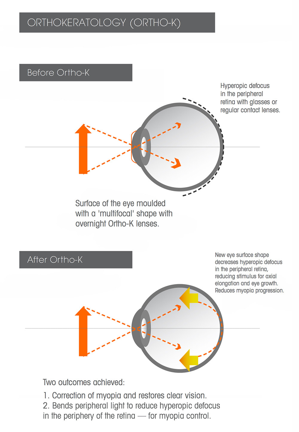 Ortho K lenses reshapes the cornea to create a multifocal effect, reducing hyperopic defocus at the peripheral retina.